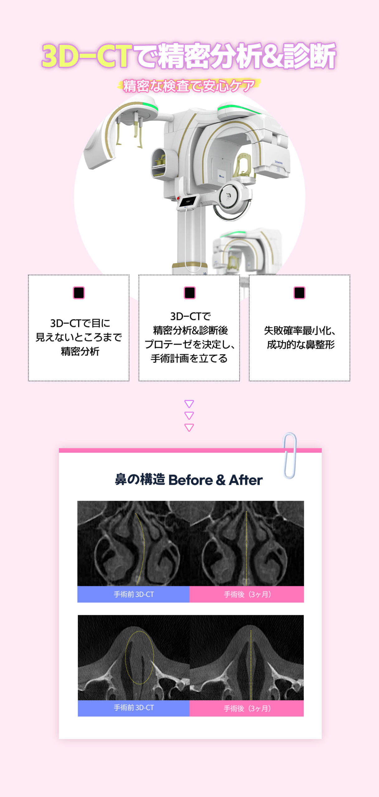韓国鼻整形おすすめ