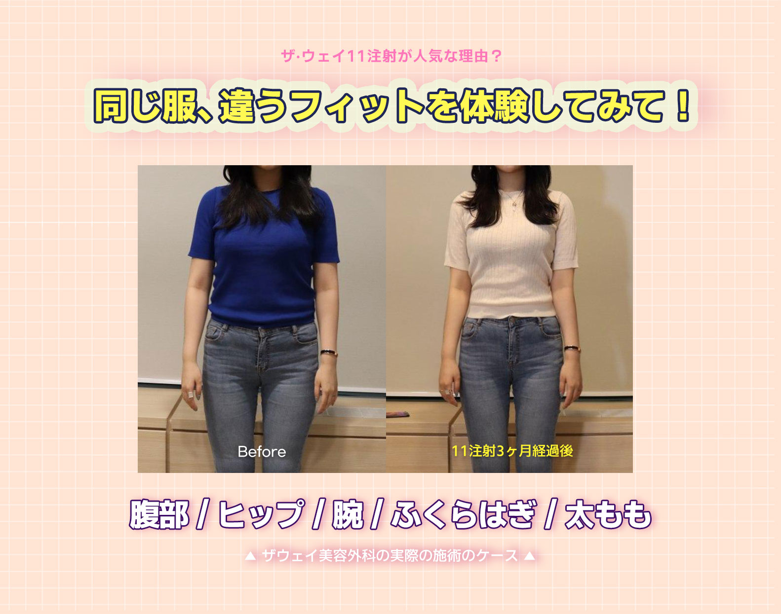 韓国脂肪溶解注射